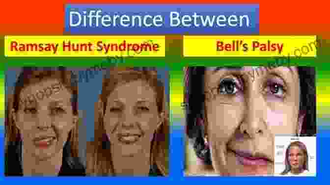 Bell Palsy And Ramsay Hunt Syndrome Fix My Face: Expert Advice For Maximizing Recovery From Bell S Palsy Ramsay Hunt Syndrome And Other Causes Of Facial Nerve Paralysis